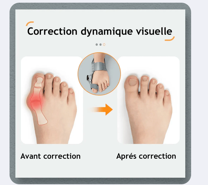 Attelle Correctrice D’Oignon Soulage La Douleur Et Aide À Réaligner Naturellement Vos Pieds Confort & Bien-Être Au Quotidien