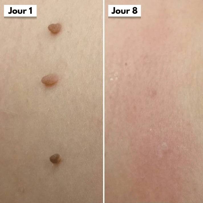 Kit DermaSkin Pro™ – Adieu Les Acrochordons, Résultat Immédiat