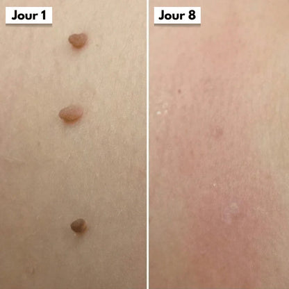 Kit DermaSkin Pro™ – Adieu Les Acrochordons, Résultat Immédiat