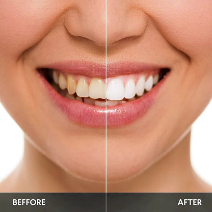 Kit de blanchiment des dents avec lumière LED